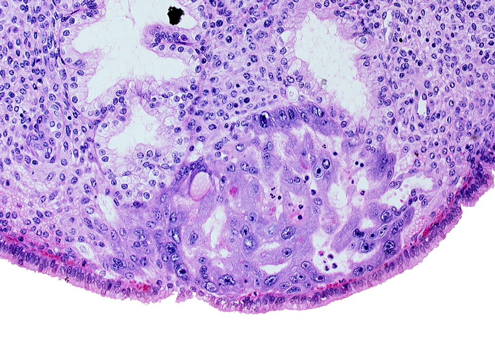 endometrial sinusoid, intact endometrial epithelium, junction of endometrial sinusoid and lacuna, lumen of endometrial gland, syncytiotrophoblast, uterine cavity