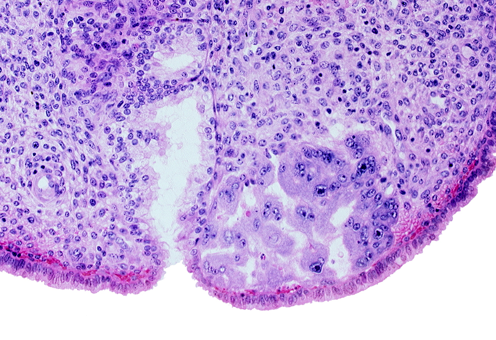 endometrial sinusoid, intact endometrial epithelium, mouth of endometrial gland, uterine cavity