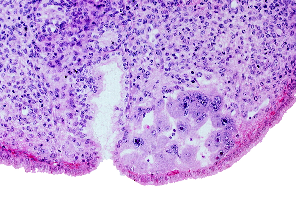 edematous endometrial stroma (decidua), intact endometrial epithelium, maternal blood cells in lacunae, mouth of endometrial gland, syncytiotrophoblast, uterine cavity