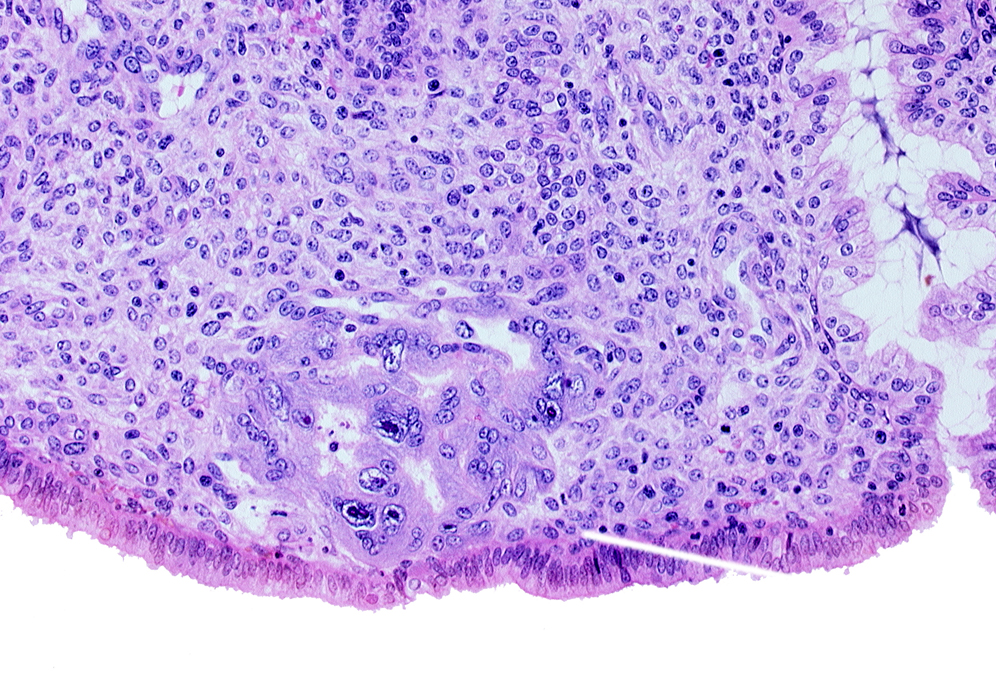 edematous endometrial stroma (decidua), endometrial sinusoid, intact endometrial epithelium, syncytiotrophoblast, trophoblast lacunae