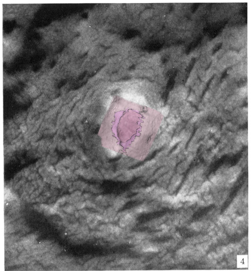 Surface view of implantation site with 3D reconstruction