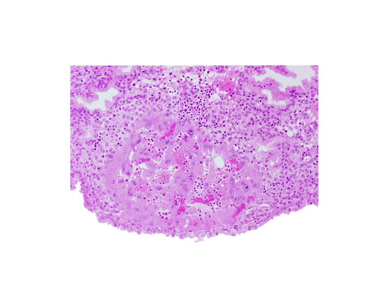 edematous endometrial stroma (decidua), endometrial epithelium, maternal blood cells in trophoblast lacuna, syncytiotrophoblast, uterine cavity