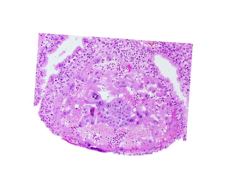 disrupted endometrial epithelium, lumen of endometrial gland, maternal blood cells in trophoblast lacuna