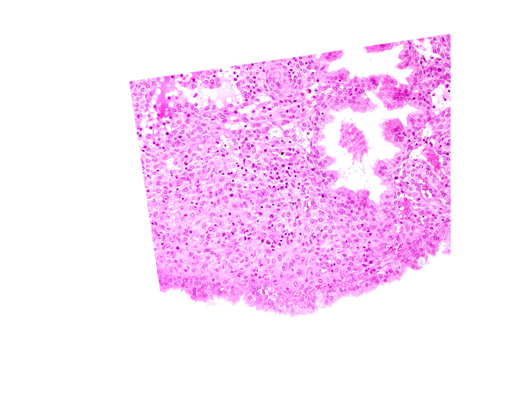 endometrial stroma (decidua), intact endometrial epithelium, uterine cavity