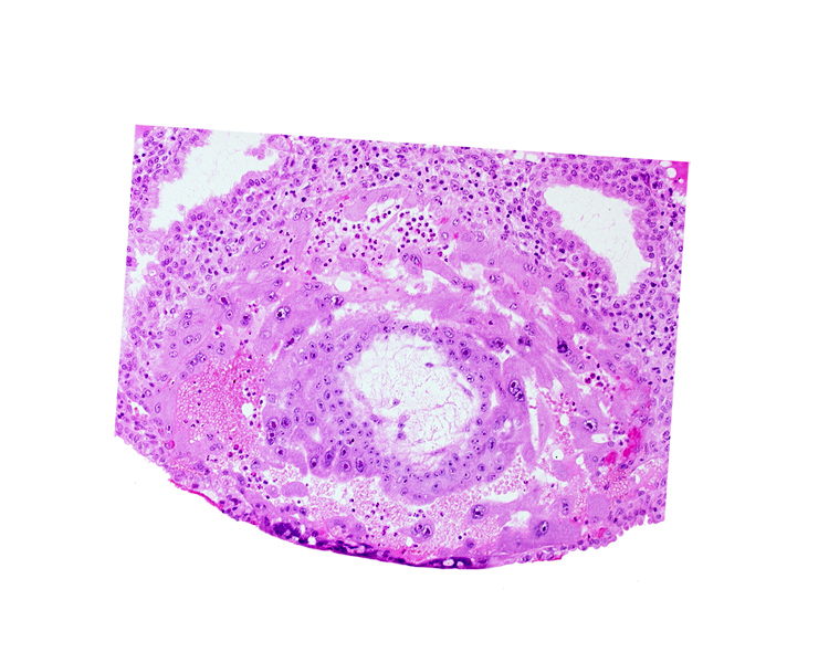 chorion, disrupted endometrial epithelium, lacunar vascular circle, uterine cavity