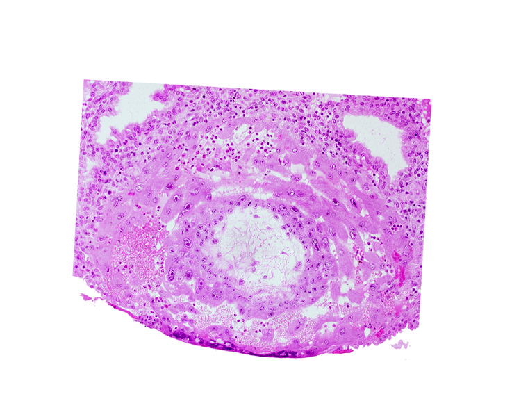 chorion, chorionic cavity, disrupted endometrial epithelium, lacunar vascular circle