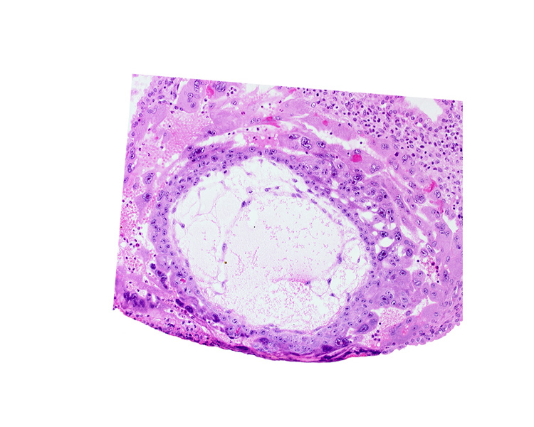 disrupted endometrial epithelium, exocoelomic (Heuser's) membrane, extra-embryonic mesoblast