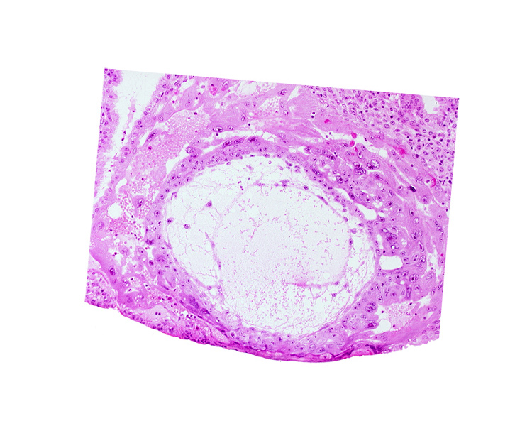 chorionic cavity, disrupted endometrial epithelium, extra-embryonic mesoblast, uterine cavity