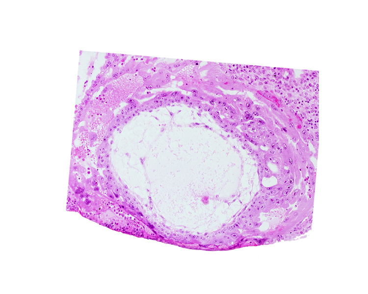 chorionic cavity, disrupted endometrial epithelium, extra-embryonic mesoblast, uterine cavity