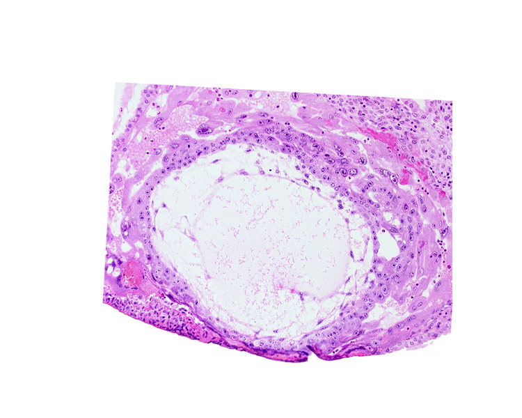 chorionic cavity, primary umbilical vesicle cavity, uterine cavity