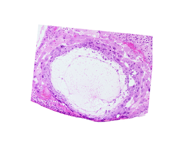 chorionic cavity, extra-embryonic mesoblast, fibrous coagulum, uterine cavity