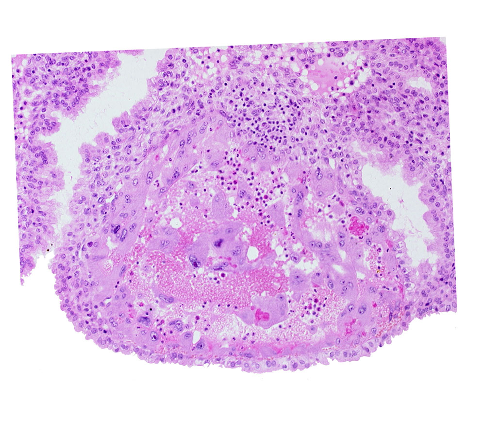 maternal blood cells in trophoblast lacuna, mouth of endometrial gland, syncytiotrophoblast