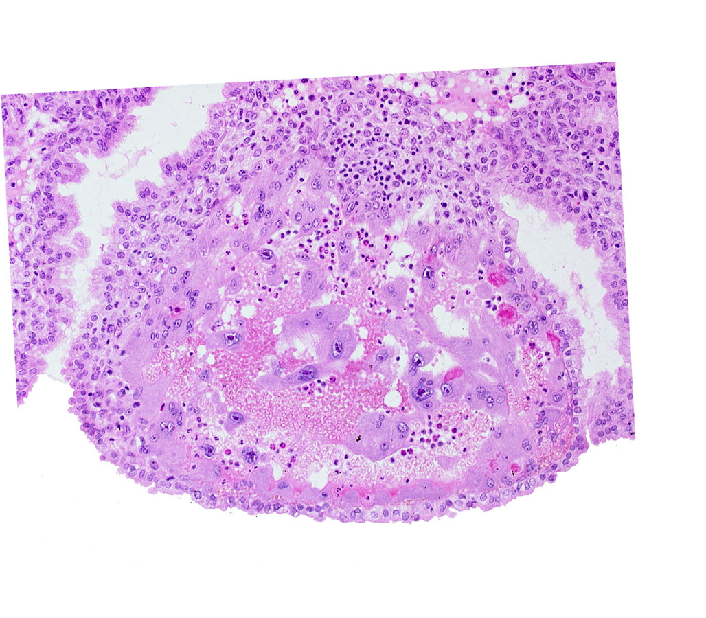 endometrial epithelium, lumen of endometrial gland, maternal blood cells in trophoblast lacuna, mouth of endometrial gland