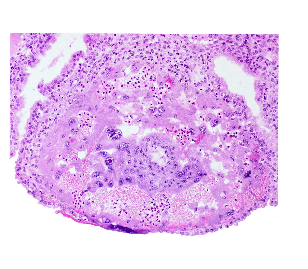 disrupted endometrial epithelium, edge of chorionic cavity, maternal blood cells in trophoblast lacuna, syncytiotrophoblast