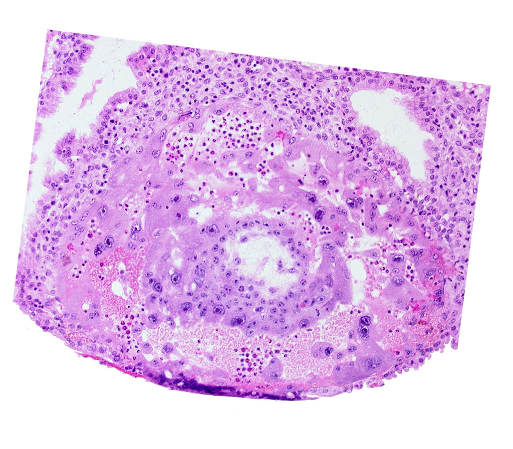 disrupted endometrial epithelium, syncytiotrophoblast