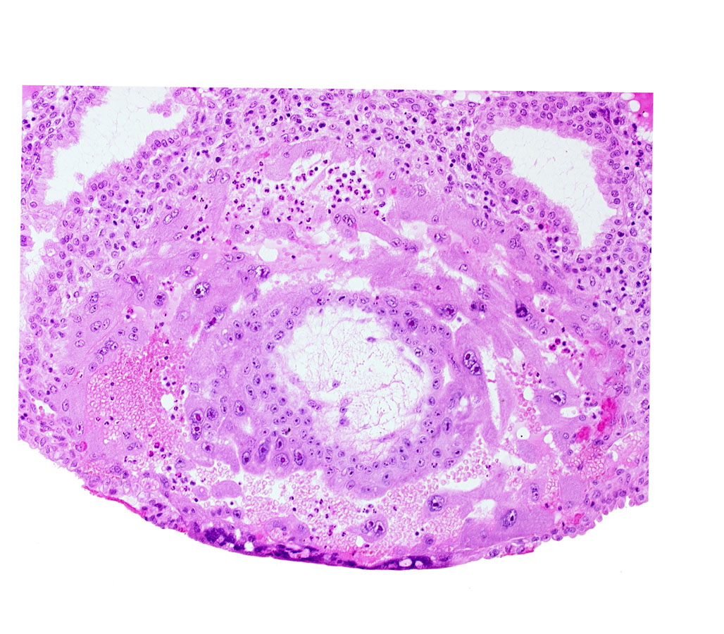 chorion, disrupted endometrial epithelium, lacunar vascular circle, uterine cavity