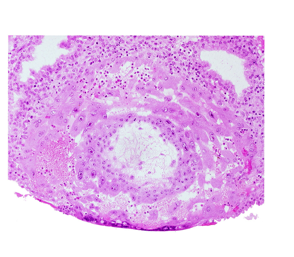 chorion, chorionic cavity, disrupted endometrial epithelium, lacunar vascular circle