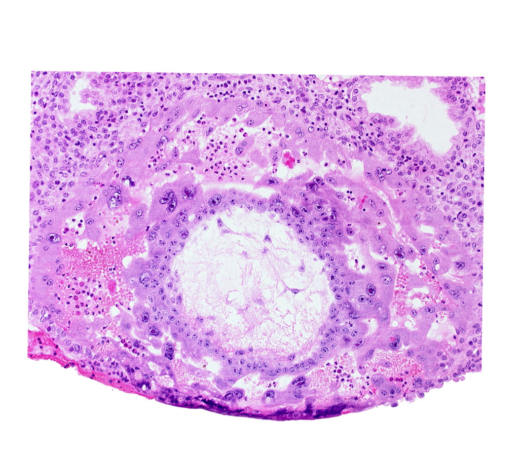 chorion, chorionic cavity, disrupted endometrial epithelium, extra-embryonic reticulum