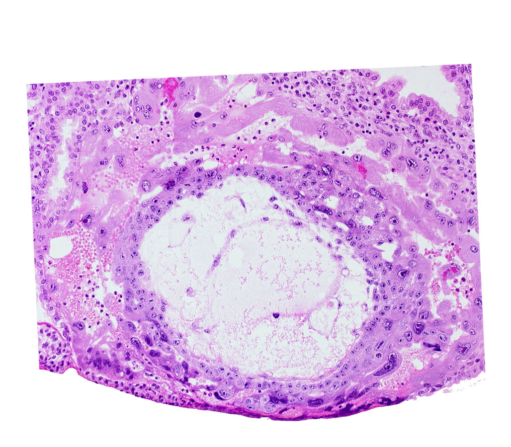 chorionic cavity, cytotrophoblast, edge of primary umbilical vesicle cavity, exocoelomic (Heuser's) membrane, extra-embryonic mesoblast, lacunar vascular circle