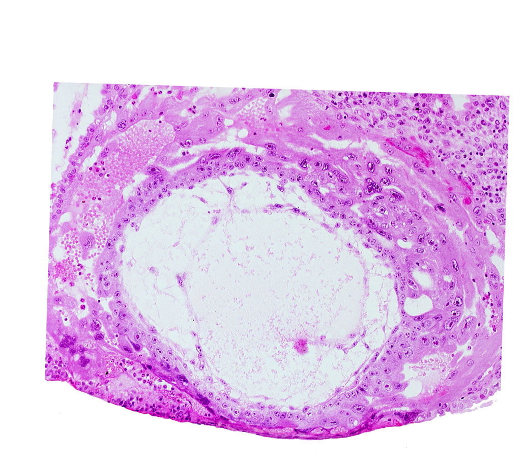 chorionic cavity, disrupted endometrial epithelium, extra-embryonic mesoblast, uterine cavity