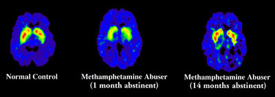 Meth Brain Scan Images