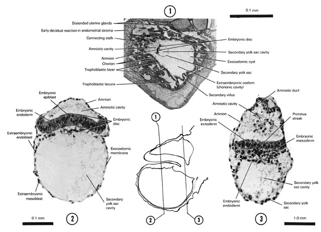 Open PDF version of FIG 2-6, The 13-day embryo with secondary villi (early trilaminar blastocyst)