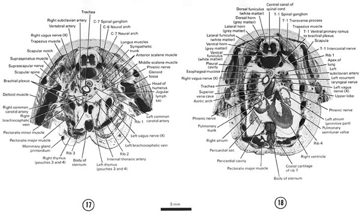 A section through the sternum, viscera at the root of the neck and C-7 spinal ganglion. A section through the caudal part of the sternum, cranial part of the heart and lungs and T-1 spinal ganglion. Open PDF version of FIG 8-11, A section through the sternum, viscera at the root of the neck and C-7 spinal ganglion. A section through the caudal part of the sternum, cranial part of the heart and lungs and T-1 spinal ganglion.