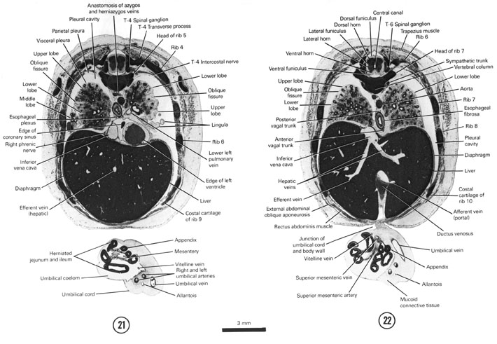 A section through the umbilical cord, caudal edge of the heart and the T-4 spinal ganglion. A section through the junction of the umbilical cord and the body wall and the T-6 spinal ganglion. Open PDF version of FIG 8-13, A section through the umbilical cord, caudal edge of the heart and the T-4 spinal ganglion. A section through the junction of the umbilical cord and the body wall and the T-6 spinal ganglion.