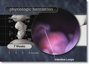 Physiologic herniation Physiologic herniation, intestine loops, appendix, and umbilical cord of the 7 week embryo.